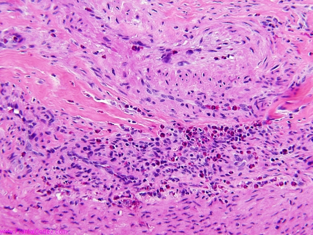 Juvenile temporal arteritis with eosinophilia in a patient with Kimura disease